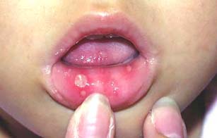 病 手足 口内炎 口 子どもの手足口病―どのような症状？