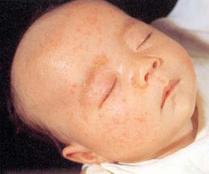 湿疹 赤ちゃん 頭皮